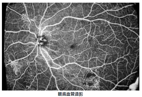 微真·血流扫频OCTA（眼科）(图3)