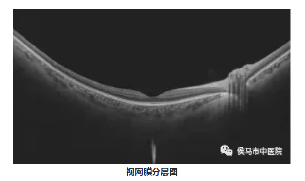 微真·血流扫频OCTA（眼科）(图4)